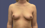 Breast Augmentation 3 Before